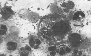 Макрофаги в состоянии фагоцитоза