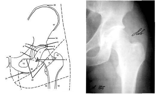 Схема рентгенограммы здорового тазобедренного сустава