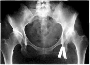 Рентгенограмма больной с двусторонней дисплазией тазобедренных суставов