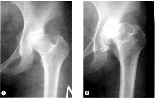 Рентгенограммы больной с коксартрозом на почве перенесенной болезни Легга-Кальве-Пертеса