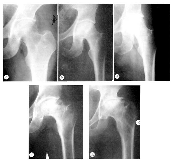 Рентгенограммы больных с различными стадиями асептического некроза головки бедренной кости