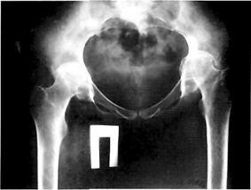 Рентгенограмма больного с двусторонним ревматоидным артритом тазобедренных суставов