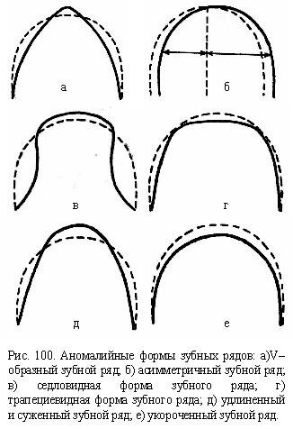 Аномалии формы зубных рядов