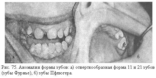 Аномалии формы зубов