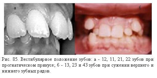 Вестибулярное положение зубов