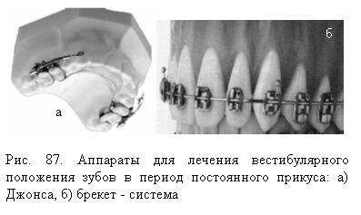 Аппараты для лечения вестибулярного положения зубов