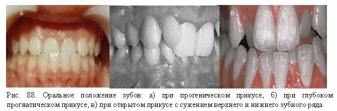 Оральное положение зубов