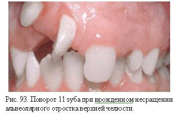 Поворот зуба