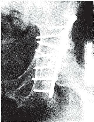 Переломы и остеосинтез вертлужной впадины