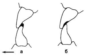 Исправление супраконтактов на передних зубах при центральной окклюзии