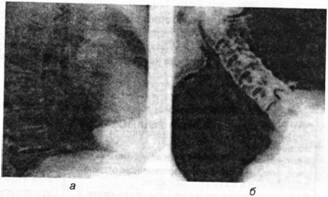 Рентгенограмма позвоночника при болезни Бехтерева в двух проекциях