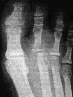 Рентгенологическая картина подагрического артрита правой ноги