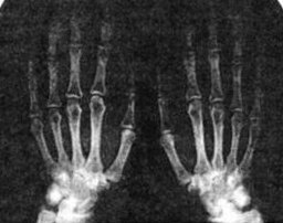 Рентгенограмма кистей