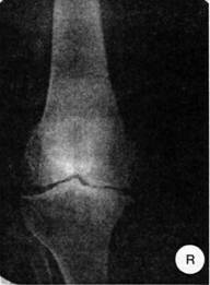 Рентгенограмма правого коленного сустава