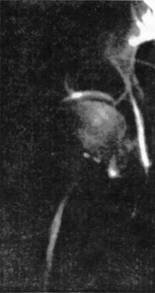 Рентгенограмма правого тазобедренного сустава