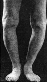 Выраженная варусная (О-образная) деформация коленных суставов