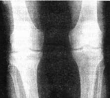 Рентгенологическая картина хондрокальциноза коленного сустава