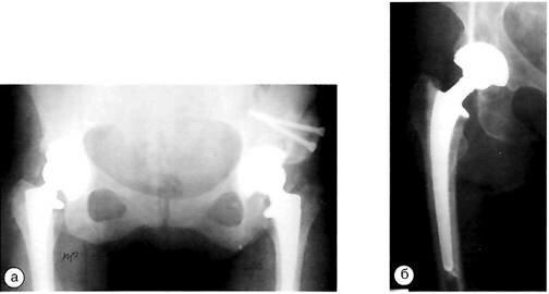 Рентгенограммы больных с различным латеральным наклоном вертлужных компонентов после эндопротезирования тазобедренного сустава