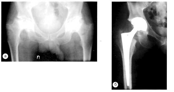 Рентгенограммы костей таза с двусторонним асептическим некрозом головок бедренных костей