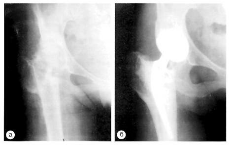 Рентгенограммы правого тазобедренного сустава с правосторонним коксартрозом, сросшимся переломом бедренной кости после медиализирующей межвертельной остеотомии