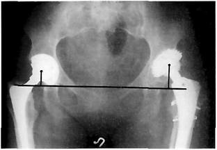 Рентгенограмма костей таза с двусторонним эндопротезироваиием тазобедренных суставов