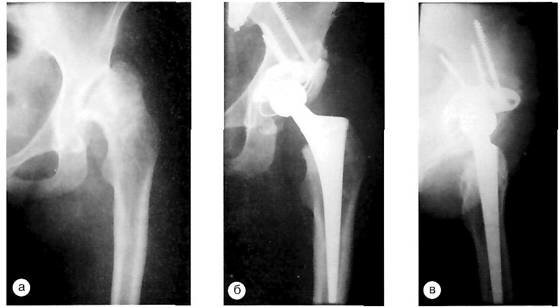 Рентгенограммы левого тазобедренного сустава через год после операции