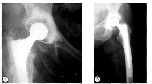 Рентгенологическая оценка цементной фиксации эндопротезов