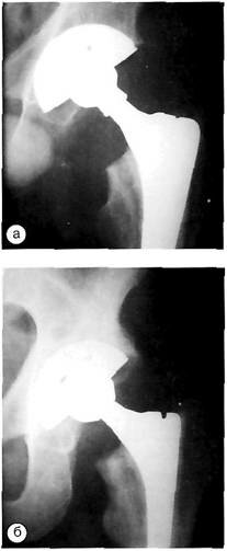 Рентгенологические признаки стабильной фиксации вертлужного компонента Trilogy, (Zimmer)