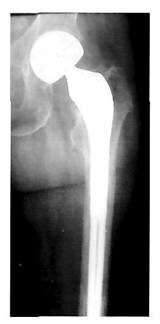 Рентгенограмма левого тазобедренного сустава больной П. через 2 года после однополюсного эндопротезирования