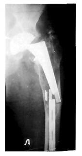 Рентгенограммы левого тазобедренного сустава больного Л. с признаками нестабильности бедренного компонента