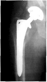 Рентгенограмма правого тазобедренного сустава через 2 года после первичного эндопротезирования по поводу асептического некроза головки бедренной кости