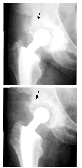 Рентгенограммы после первичной артропластики правого тазобедренного сустава