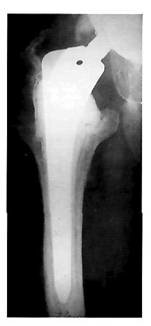 Рентгенограмма через 2 года после ревизионной артропластики правого тазобедренного сустава с установкой ножки эндопротеза на костный цемент
