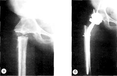 Рентгенограммы с анкилозом правого тазобедренного сустава, ложным суставом верхней трети бедра после корригирующей остеотомии