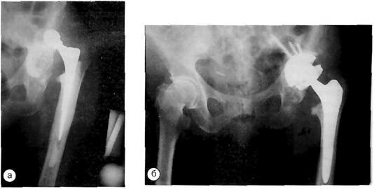 Рентгенограммы с рецидивирующим вывихом левого бедра, нестабильностью бедренного компонента эндопротеза