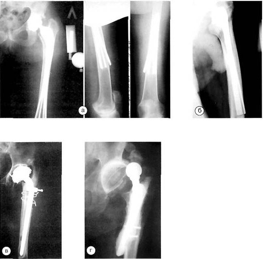Рентгенограммы больных после первичной артропластики