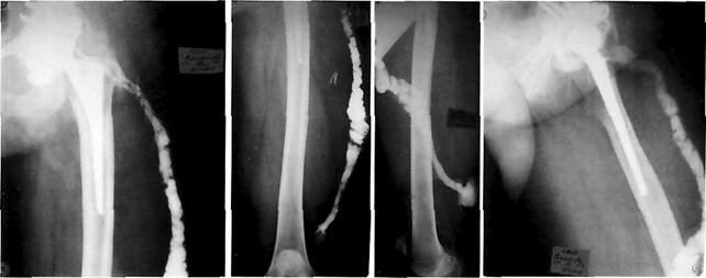 Рентгенфистулография левого тазобедренного сустава и левого бедра - параэндопротезная инфекция