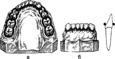 Шинирование зубов ортопедическое лечение thumbnail