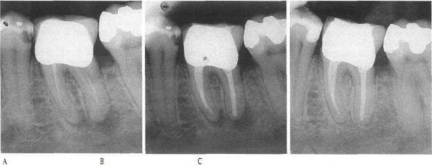 Апикальный периодонтит. Периапикальный периодонтит. Пломбирование зуба после лечения каналов