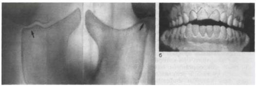 Ревматоидный артрит и стоматология thumbnail