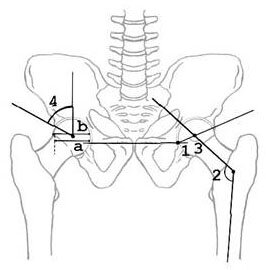 Рентгенологические критерии, характеризующие стабильность тазобедренного сустава