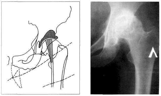Схема рентгенограммы тазобедренного сустава больной с деформирующим артрозом