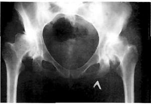 Рентгенограмма больного с двухсторонним диспластическим коксартрозом III ст